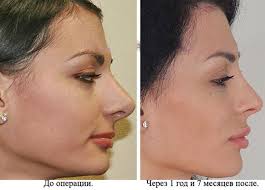 пластика носа